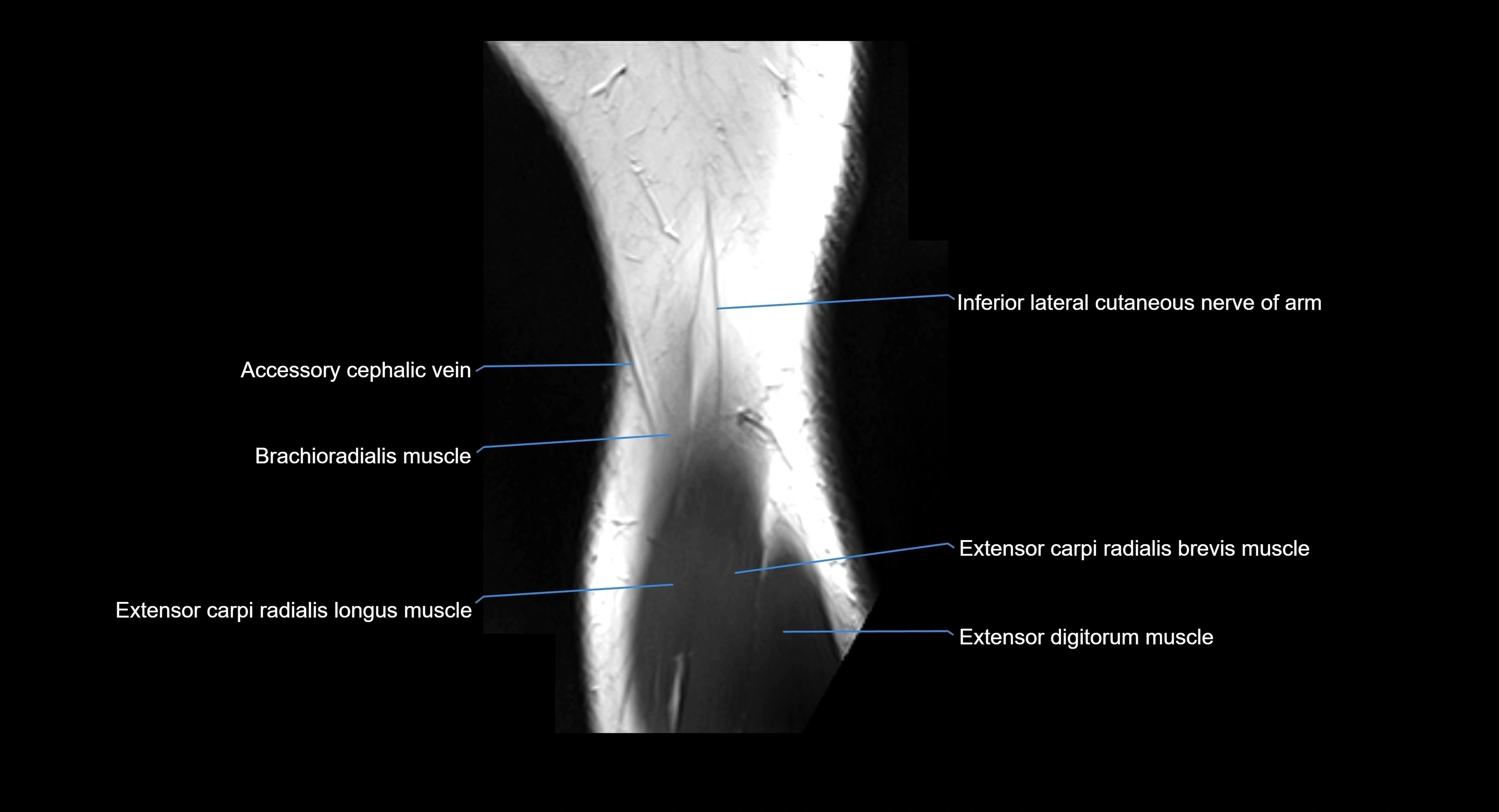 MRI elbow joint  sagittal cross sectional anatomy 3T  radiology  image-img-00001-00025.webp